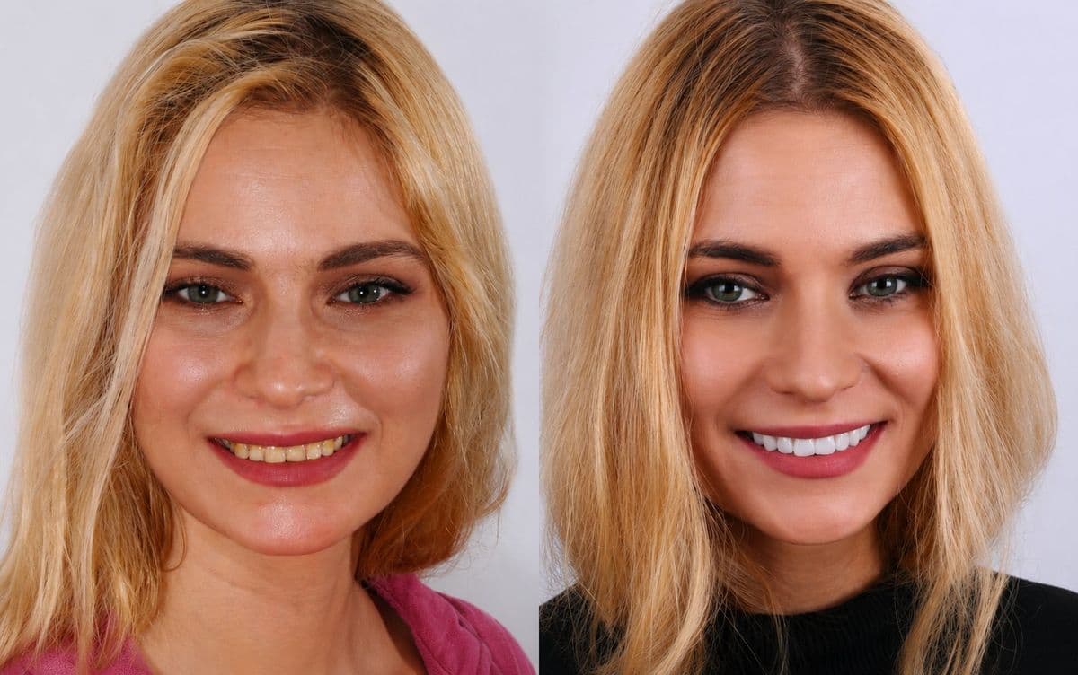 Faccette dentali — caso clinico reale del nostro studio